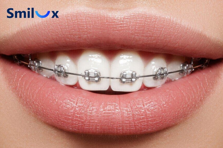 Có nên kết hợp bọc răng sứ và niềng răng không? Có nên kết hợp bọc răng sứ và niềng răng không?