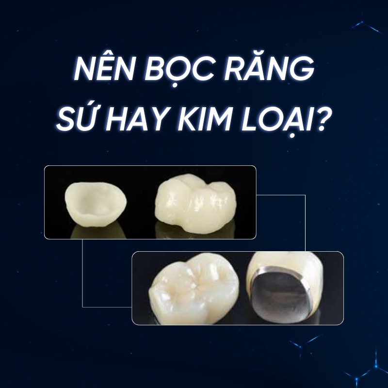 Nên bọc răng sứ hay kim loại smilux dental