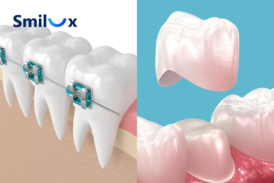 Nên niềng răng hay bọc sứ tốt hơn? Nên niềng răng hay bọc sứ tốt hơn?