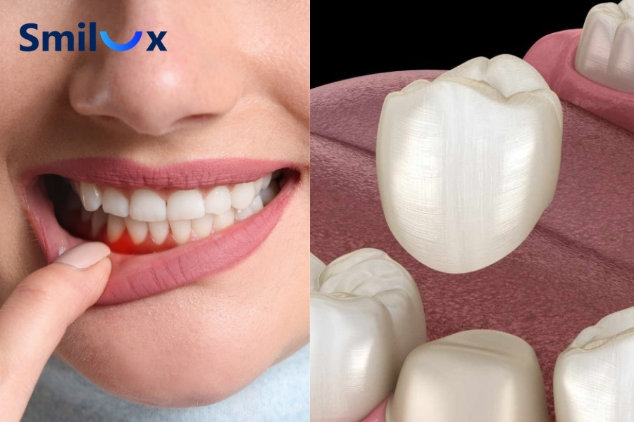 Người bị nha chu có bọc răng sứ được không? Người bị nha chu có bọc răng sứ được không?