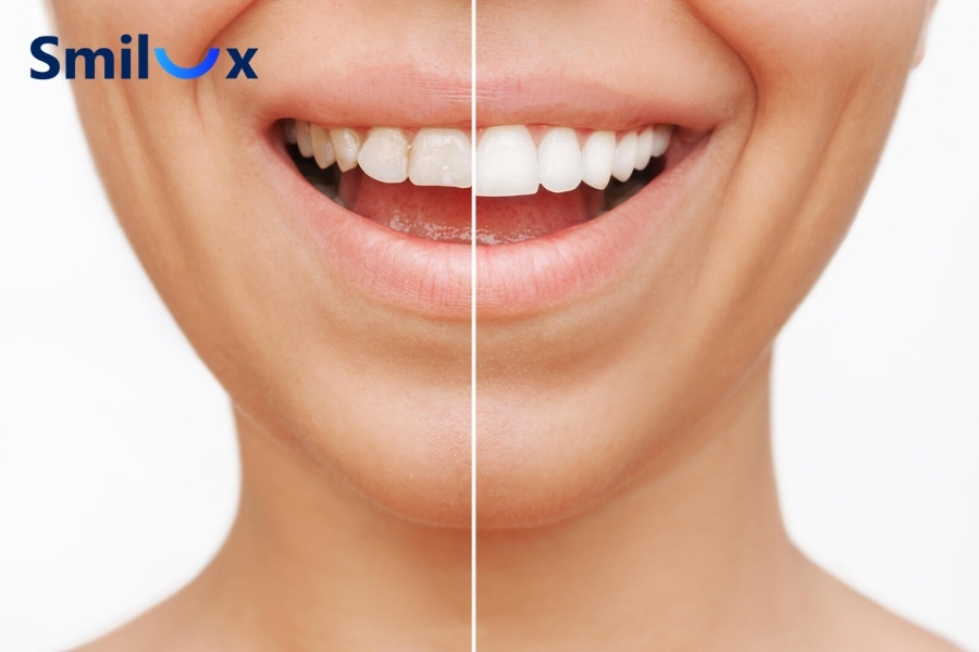 Những trường hợp nên bọc răng sứ Những trường hợp nên bọc răng sứ