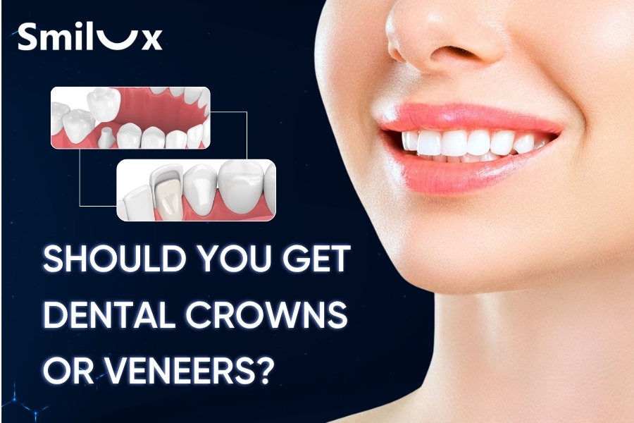 Should You Get Dental Crowns or Veneers? Which Option Is Better? Should You Get Dental Crowns or Veneers? Which Option Is Better?