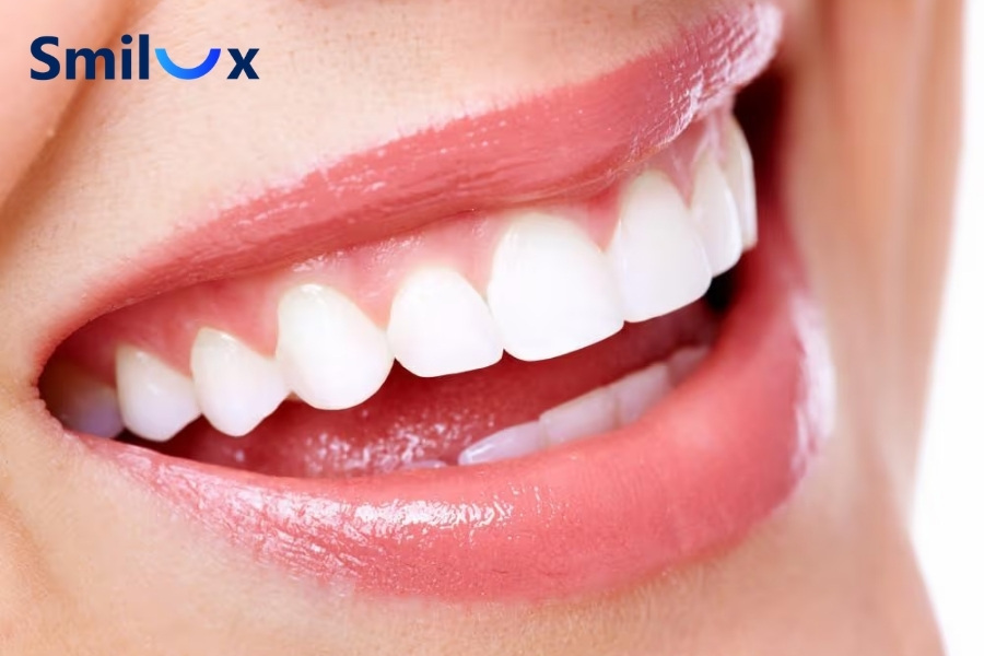 Ưu điểm của bọc răng sứ Ưu điểm của bọc răng sứ