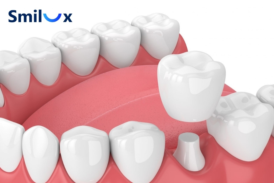 Bọc răng sứ có tốt không? Bọc răng sứ có tốt không?