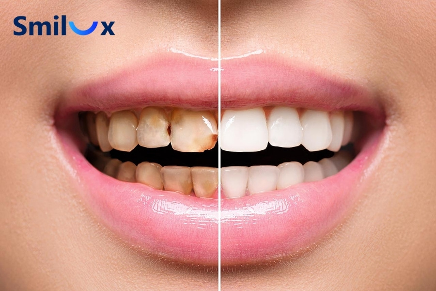 Bọc răng sứ bao lâu thì phải làm lại? Bọc răng sứ bao lâu thì phải làm lại?