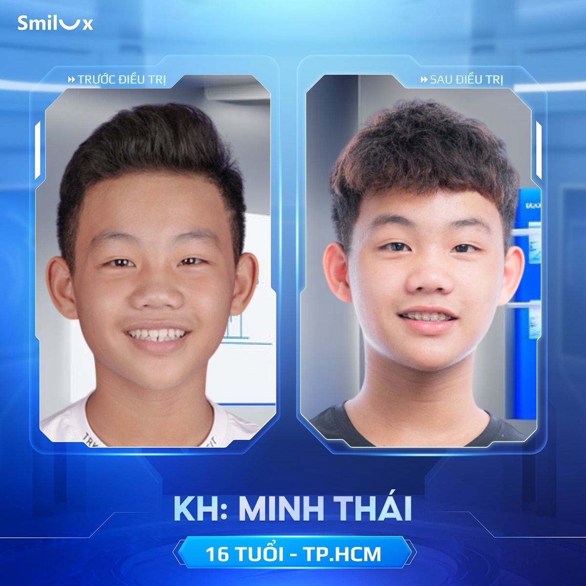 khách hàng thực tế niềng răng 4