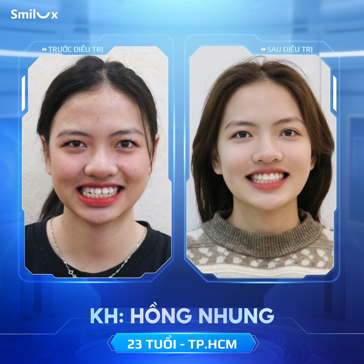 khách hàng thực tế niềng răng 9