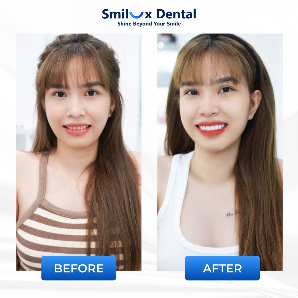 khách hàng trước sau bọc sứ 1