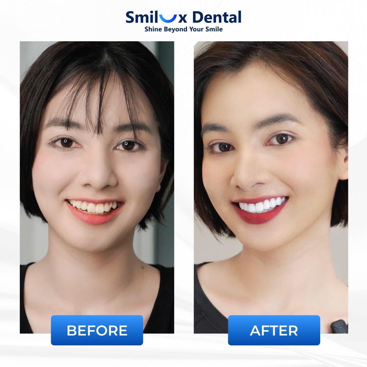 khách hàng trước sau bọc sứ 2