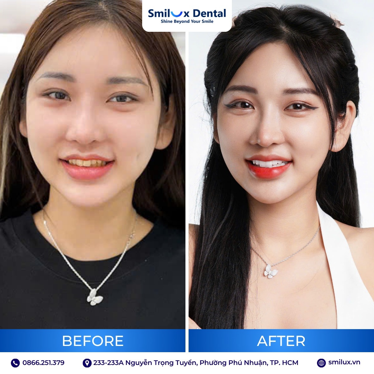 khách hàng trước sau bọc sứ 3