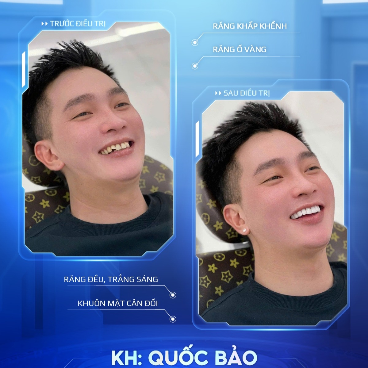 khách hàng trước sau bọc sứ 4