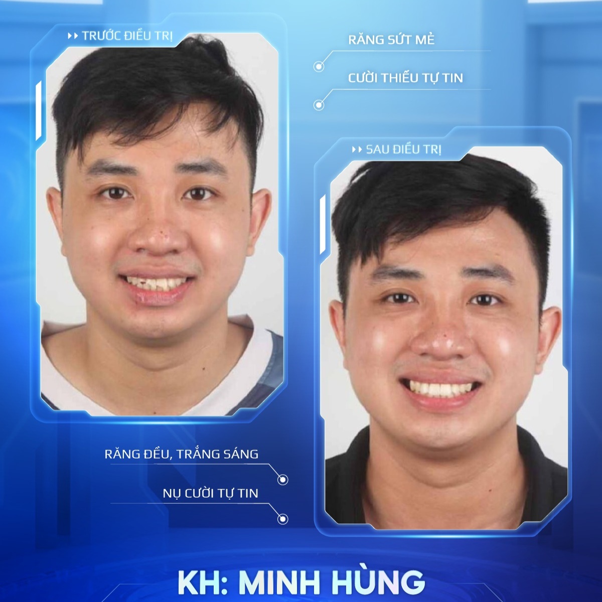 khách hàng trước sau bọc sứ 5