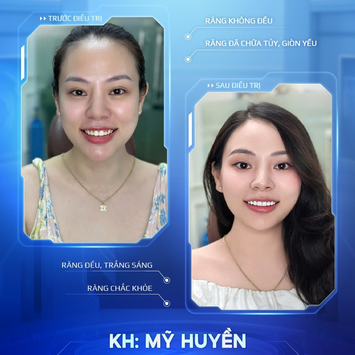 khách hàng trước sau bọc sứ 6