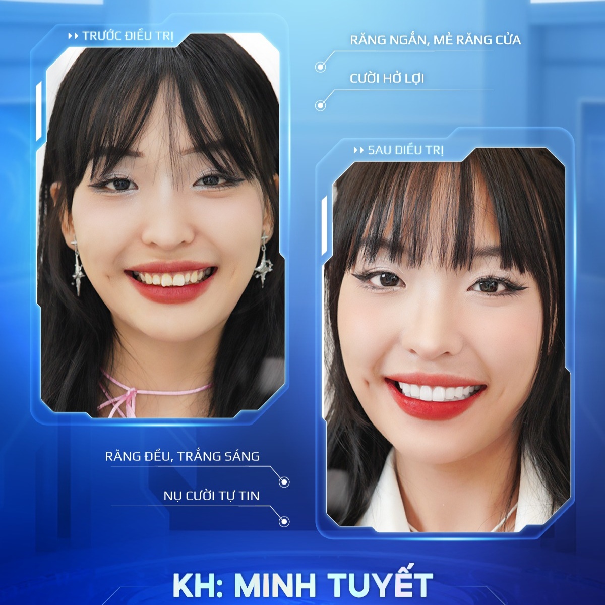 khách hàng trước sau bọc sứ 7