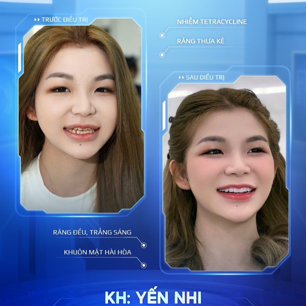 khách hàng trước sau bọc sứ 8