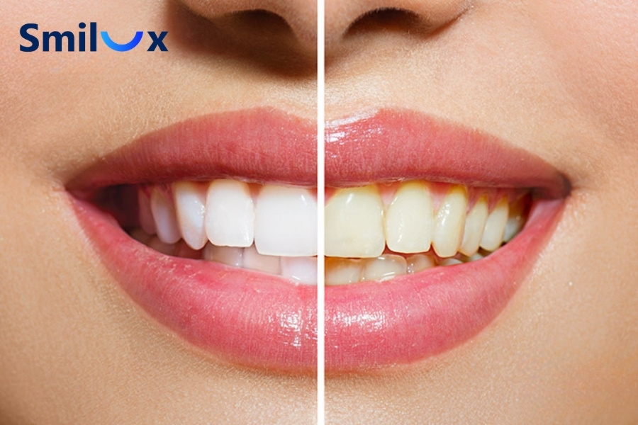 Răng sứ có thể bị ố vàng sau một thời gian sử dụng Răng sứ có thể bị ố vàng sau một thời gian sử dụng