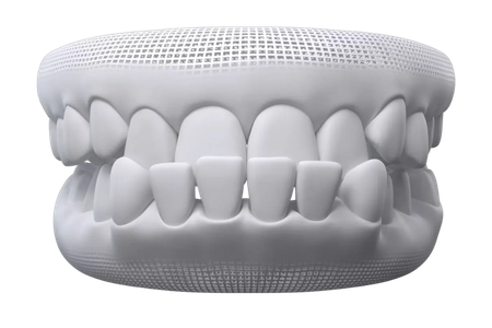 mô hình răng bị khớp cắn ngược