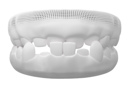 mo hinh rang sai khop can