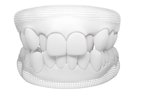 mo hinh rang sai lech khop can 1