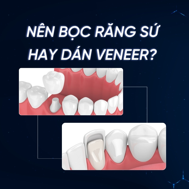 nên bọc răng sứ hay dán Veneer smilux dental