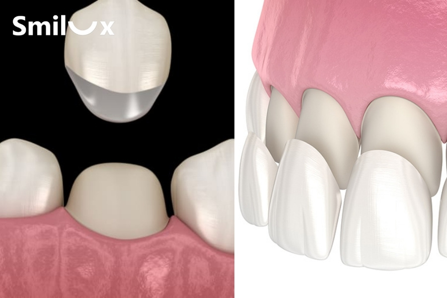 Nên bọc răng sứ hay dán Veneer thì tốt hơn?