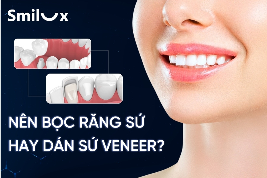 Nên bọc răng sứ hay dán Veneer? Phương pháp nào tốt hơn Nên bọc răng sứ hay dán Veneer? Phương pháp nào tốt hơn