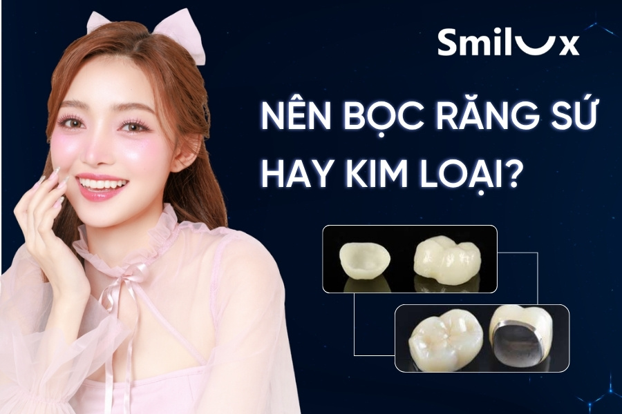 Giải đáp: Nên bọc răng sứ hay kim loại? Loại nào tốt hơn? Giải đáp: Nên bọc răng sứ hay kim loại? Loại nào tốt hơn?