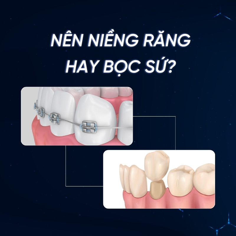 nên niềng răng hay bọc sứ smilux dental