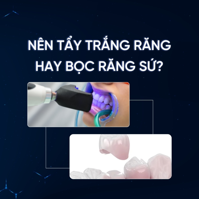 nên tẩy trắng răng hay bọc sứ smilux dental