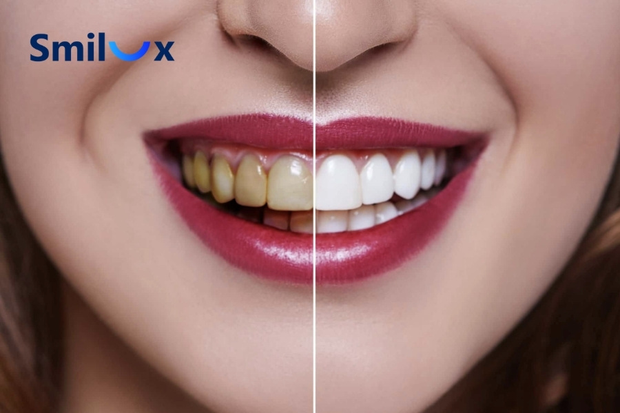 Nên tẩy trắng răng hay bọc sứ? Nên tẩy trắng răng hay bọc sứ?