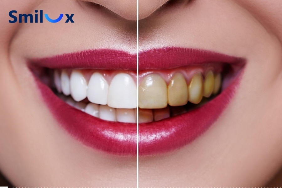 Khi nướu tụt, cổ răng sứ dễ xuất hiện viền vàng hoặc sẫm màu Khi nướu tụt, cổ răng sứ dễ xuất hiện viền vàng hoặc sẫm màu