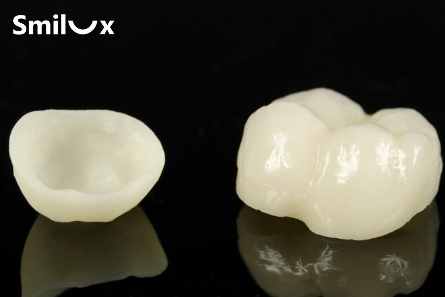 Răng sứ bị đổi màu theo thời gian phụ thuộc trực tiếp vào cấu tạo răng sứ Răng sứ bị đổi màu theo thời gian phụ thuộc trực tiếp vào cấu tạo răng sứ