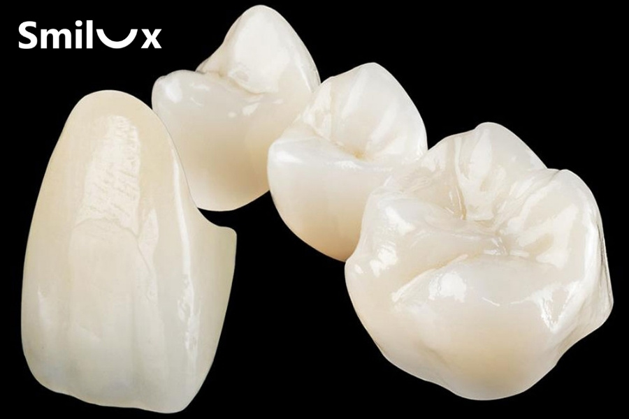 Răng sứ bị ố vàng do chấn thương Răng sứ bị ố vàng do chấn thương