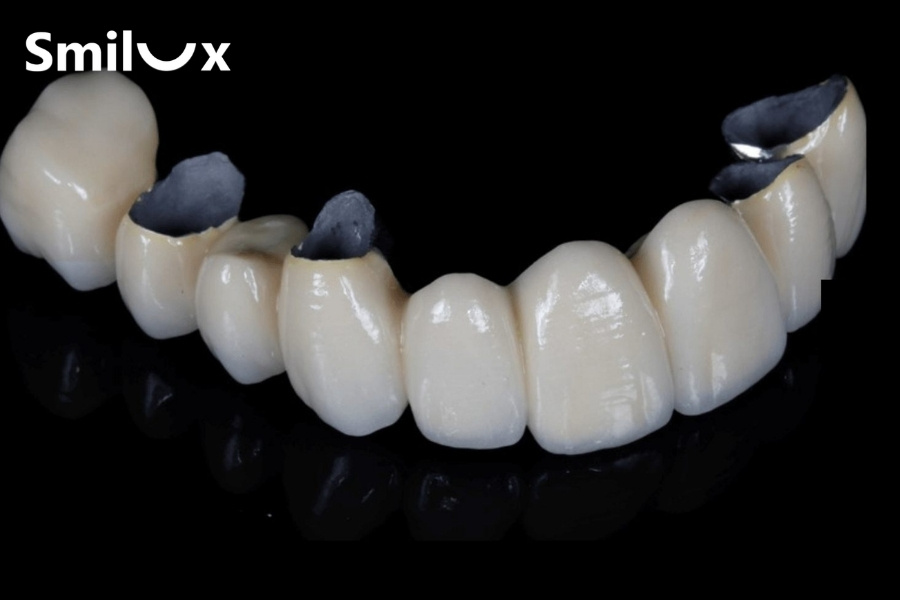 Răng sứ kim loại là gì? Răng sứ kim loại là gì?