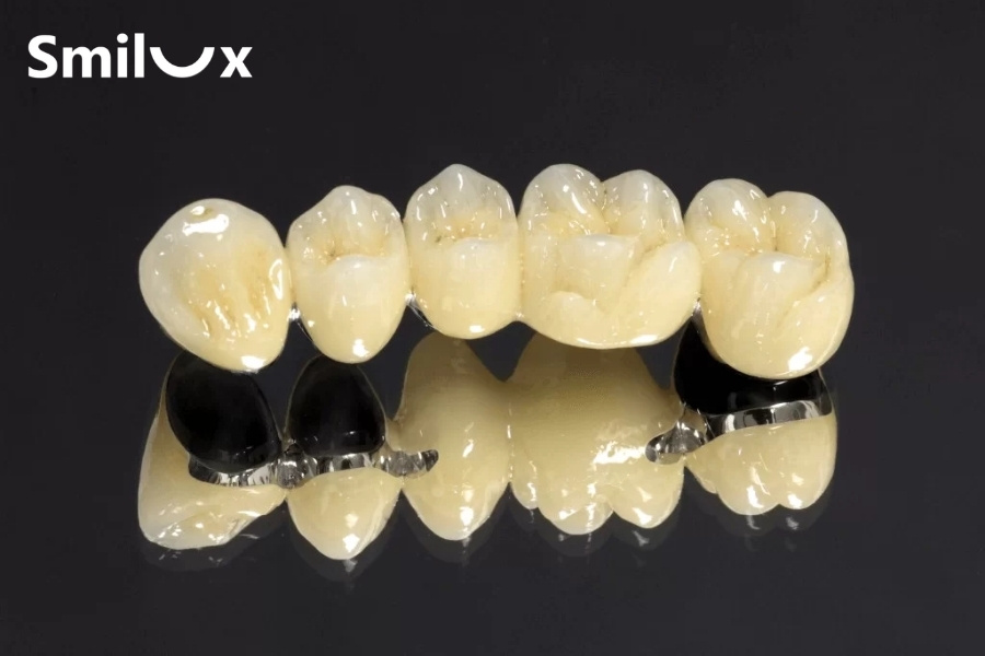 Răng sứ Titan là gì? Răng sứ Titan là gì?