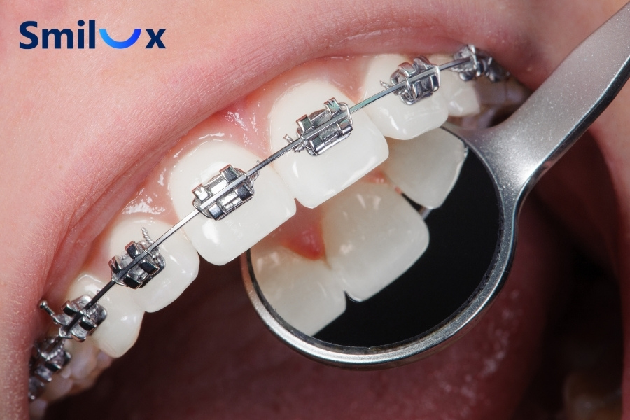 Ảnh hưởng tiêu cực khi niềng răng sai cách Ảnh hưởng tiêu cực khi niềng răng sai cách