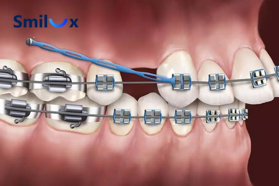Vị trí đặt vít ảnh hưởng đến cảm giác đau sau khi cắm Vị trí đặt vít ảnh hưởng đến cảm giác đau sau khi cắm