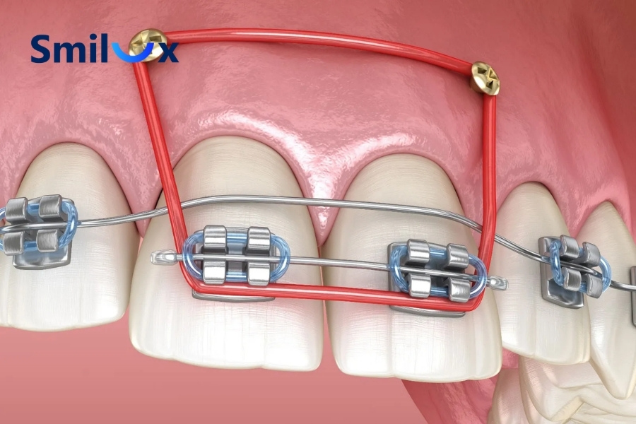 Minivis là vít Titanium nhỏ được đặt vào xương hàm để tạo điểm neo Minivis là vít Titanium nhỏ được đặt vào xương hàm để tạo điểm neo