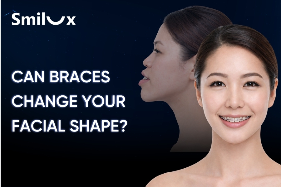 Can Braces Change Your Facial Shape? Side Profile Before and After Can Braces Change Your Facial Shape? Side Profile Before and After