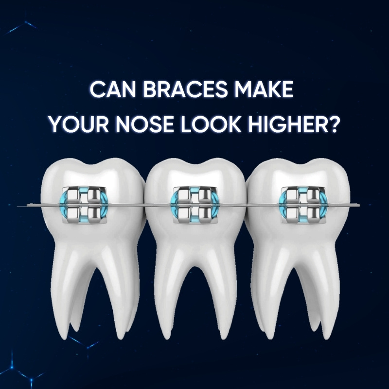 Can Braces Make Your Nose Look Higher smilux dental