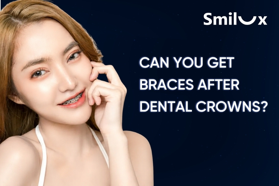 Can You Get Braces After Dental Crowns? Smilux Dentists Explain Can You Get Braces After Dental Crowns? Smilux Dentists Explain