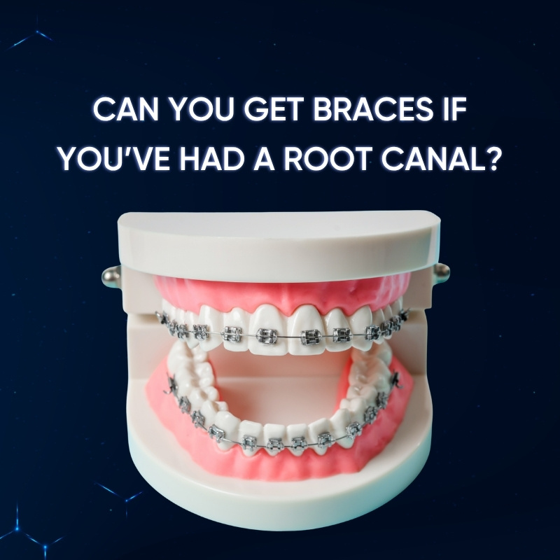 Can You Get Braces If You’ve Had a Root Canal smilux dental