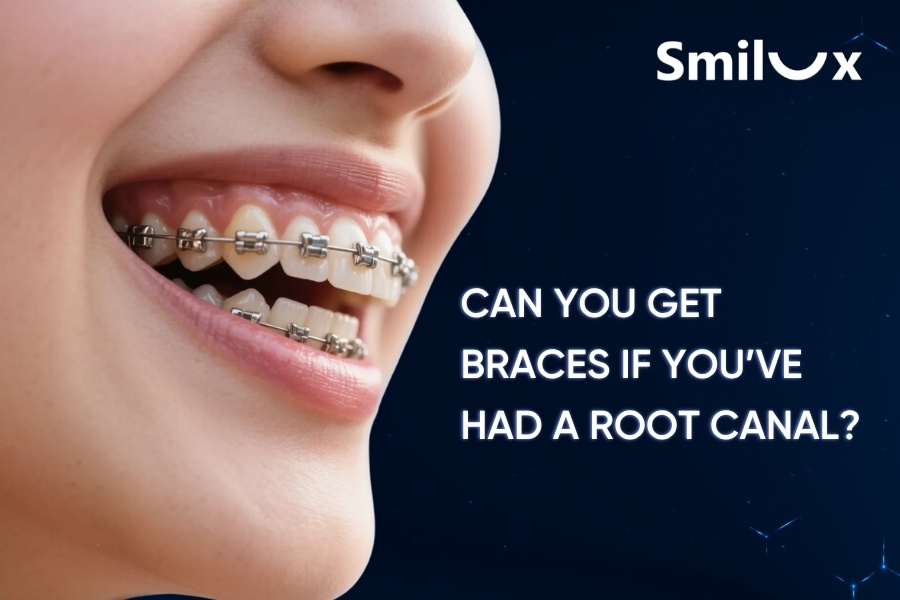 Can You Get Braces If You’ve Had a Root Canal? Key Things to Know Can You Get Braces If You’ve Had a Root Canal? Key Things to Know