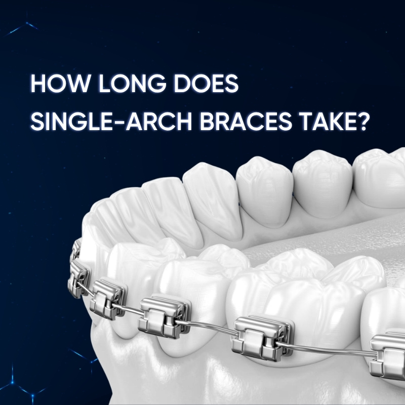 How Long Does Single-Arch Braces Take?