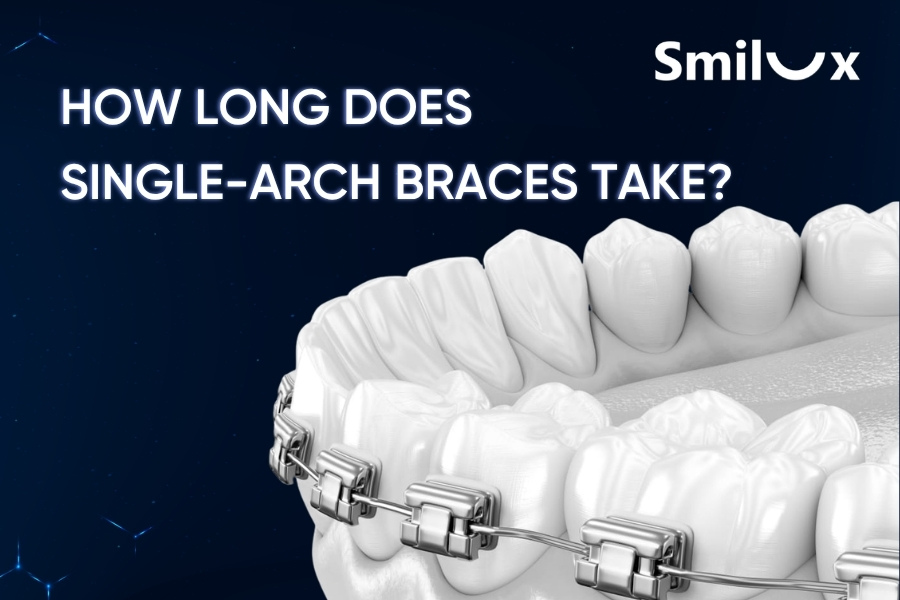 How Long Does Single-Arch Braces Take? Key Factors That Affect the Timeline How Long Does Single-Arch Braces Take? Key Factors That Affect the Timeline