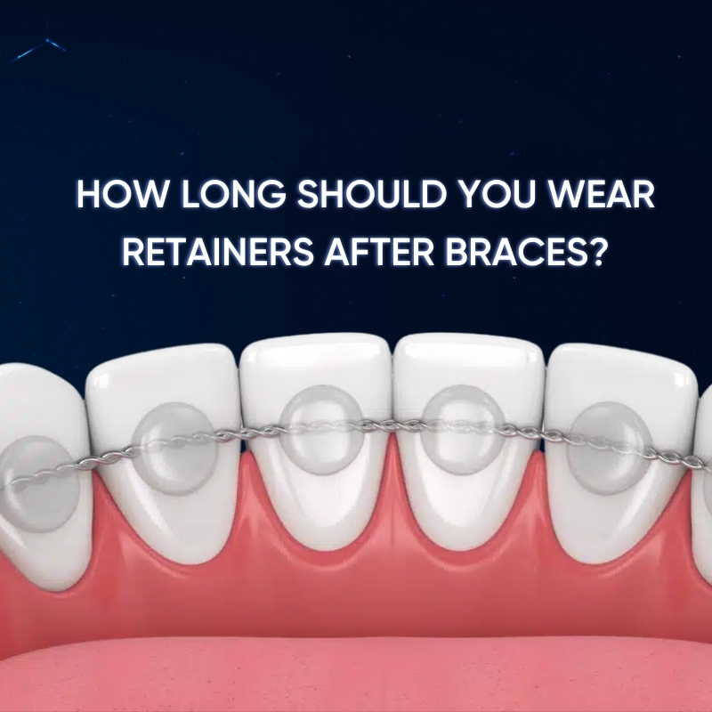 How Long Should You Wear Retainers After Braces?