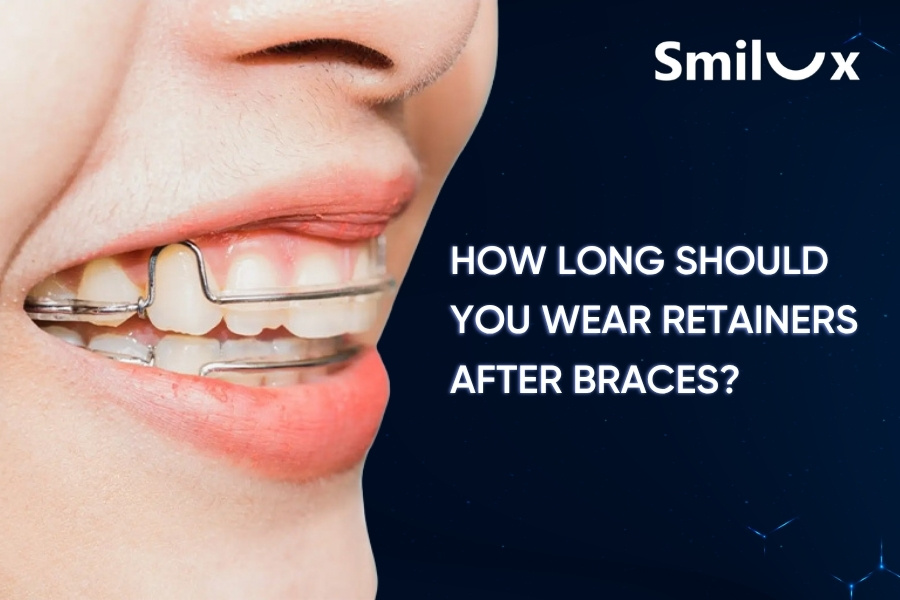 How Long Should You Wear Retainers After Braces? How Long Should You Wear Retainers After Braces?