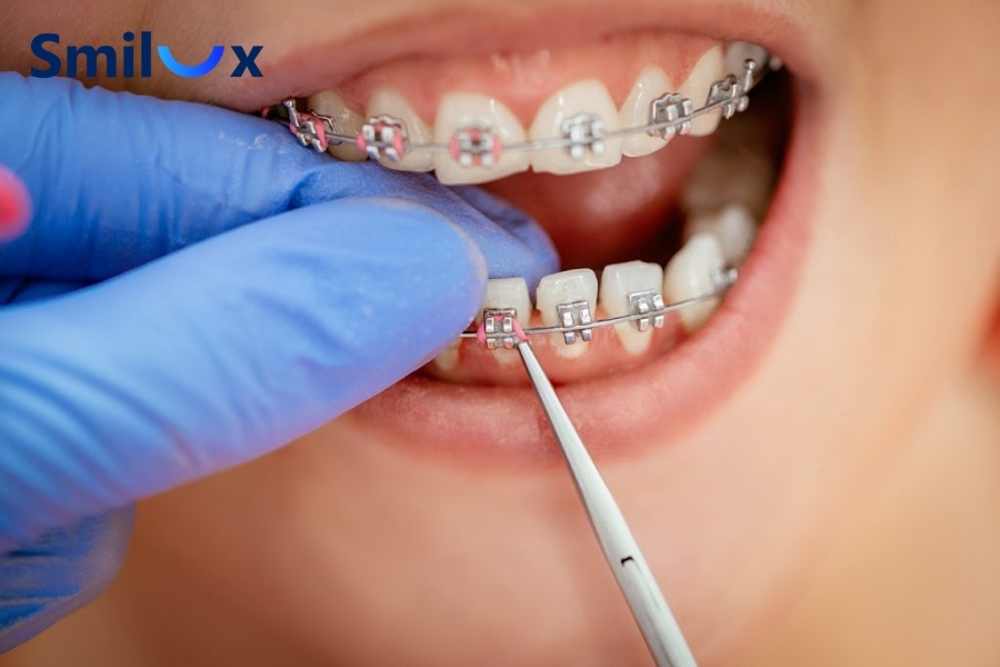 Làm răng sứ vẫn có thể niềng răng được Làm răng sứ vẫn có thể niềng răng được