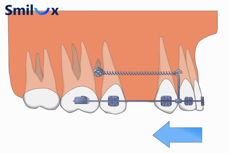 Minivis giúp kiểm soát lực kéo, đưa răng về đúng vị trí nhanh và chính xác hơn. Minivis giúp kiểm soát lực kéo, đưa răng về đúng vị trí nhanh và chính xác hơn.