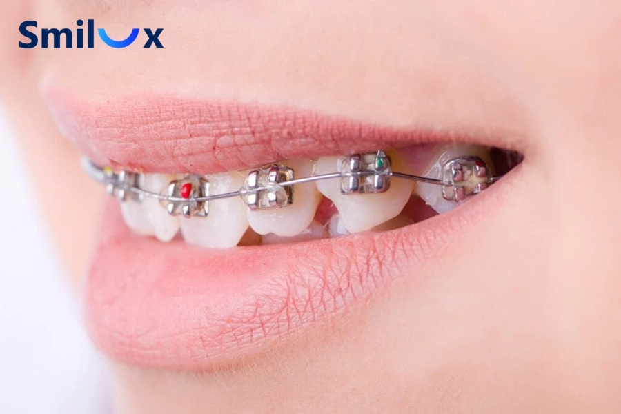 Niềng răng 1 hàm thường mất khoảng 6 đến 24 tháng Niềng răng 1 hàm thường mất khoảng 6 đến 24 tháng